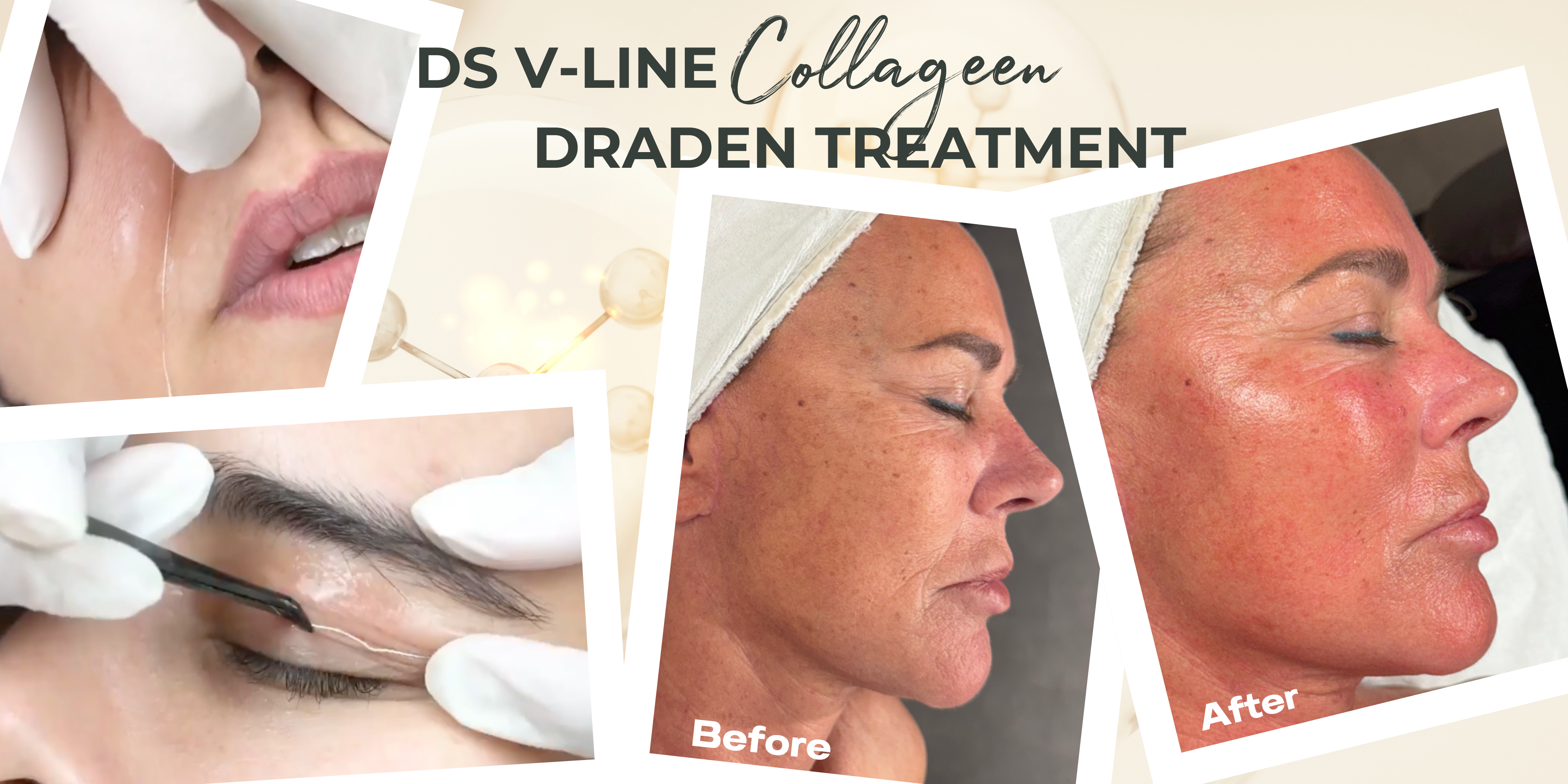 NEW LAUNCH TREATMENT DS V-Line Collageen Draden